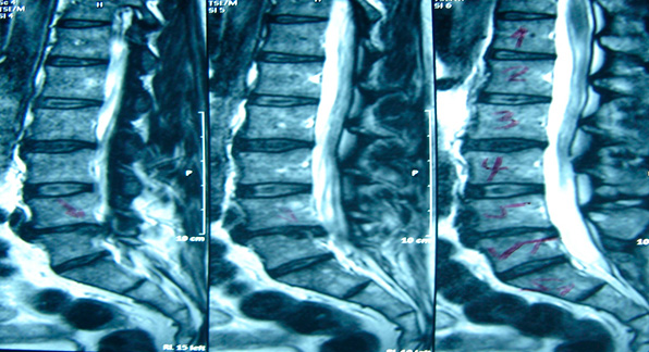 Artrodese Lombar CRL Neurocirurgia